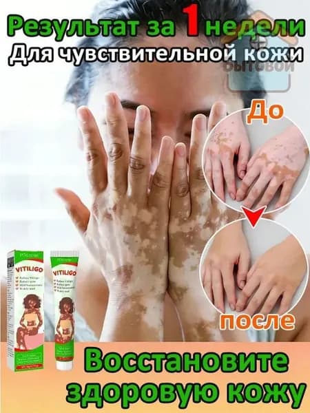 Мазь от витилиго,Средство при нежелательной пигментации витилиго.60 мл