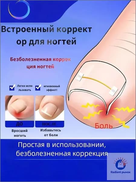 Комплект из 10 никелид-титановых корректоров для вросших ногтей