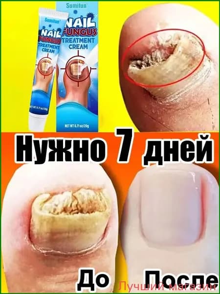 Противогрибковый крем Ланбина, 20 г, применяемый при онихолизисе и грибке, считается качественным средством для оздоровления и укрепления стоп и кистей.