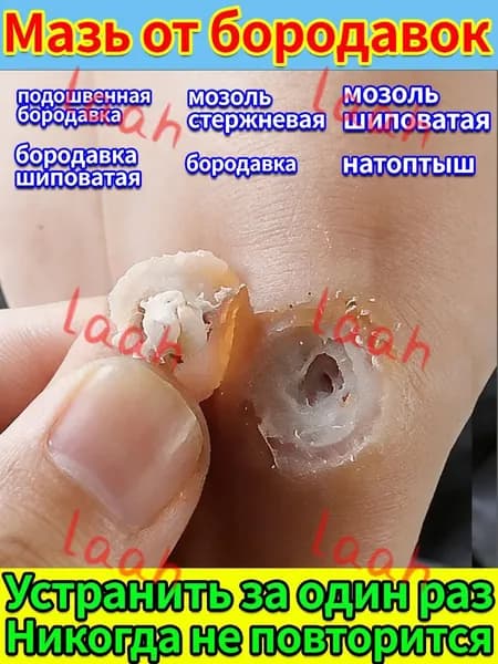 Паста для удаления шипиц и бородавок - лечение натоптышей на подошве