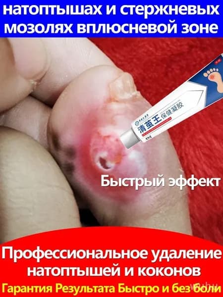 Бактерицидный крем, крем для ухода за ногами для подсушивания мозолей и натоптышей