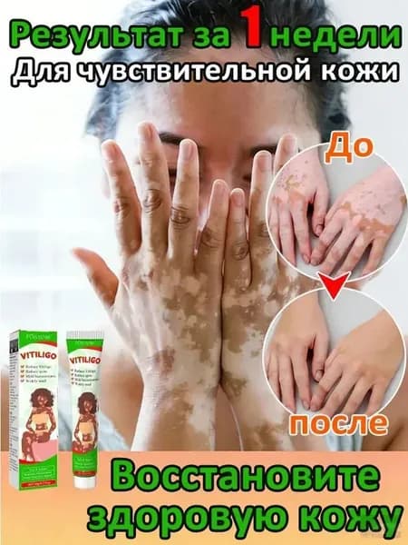 Мазь от витилиго,Средство при нежелательной пигментации витилиго.20 мл