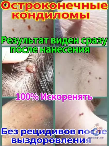 Лекарство от папиллом и бородавок, эффективно удаляет бородавки и папилломы, кондиломы с лица и тела, не оставляя шрамов, 20 гм