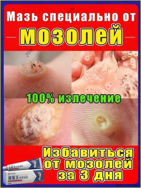 Эффективный крем для быстрого избавления бородавок, мозольный удаления мозолей, натоптышей,средство от шипиц на ногах,китайская чудо мазь 20 г от мазолей и надоптвшей,колломак от бородавок