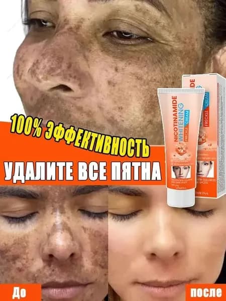 Крем для удаления веснушек и отбеливания способен удалить веснушки, хлоазму, солнечные пятна, пигментные пятна, улучшить тусклый тон кожи, бороться с пигментацией и выравнивать тон кожи.60ml