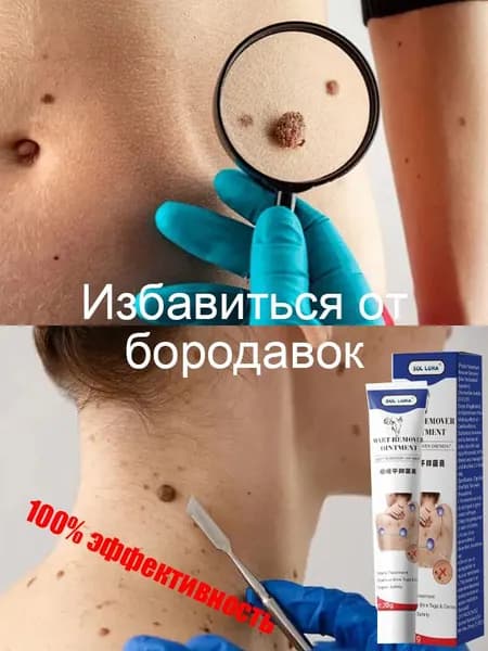 Средство для удаления бородавок, используется для удаления папиллярных бородавок и родинок, безболезненно, без побочных эффектов, натуральные растительные ингредиенты, 20 г крема от бородавок